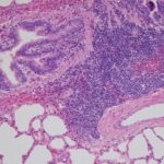 Lung pathology in Mycoplasma bovis-infected cattle at 10x magnification. (VIDO.org)