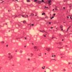 A microscope-level view of damaged brain tissue from a cow infected with BSE. (USDA photo via U.S. Food and Drug Administration)